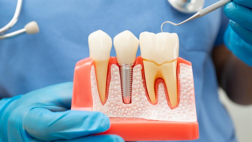 Dentist showing model of implant