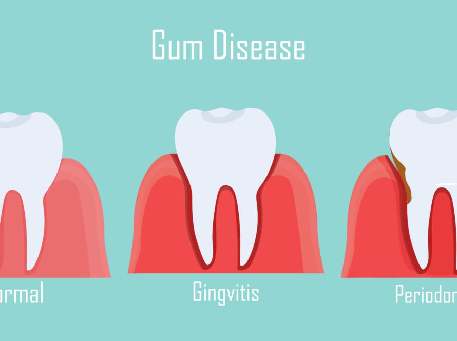 Illustration showing normal gums, gingivitis with inflamed gums, and periodontitis with gum recession and bone loss.