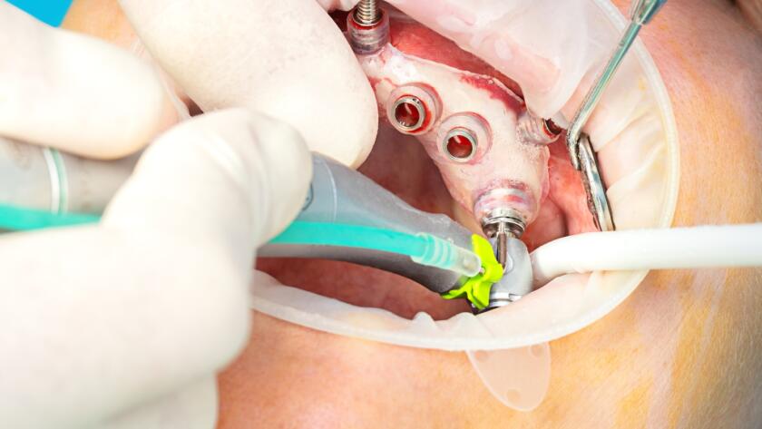 Dental implant placement procedure in a controlled clinical setting
