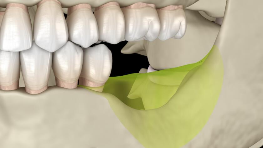 Jaw bone loss after tooth extraction affecting future dental implant placement