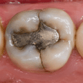 Why Teeth Crack More Often After Large Fillings